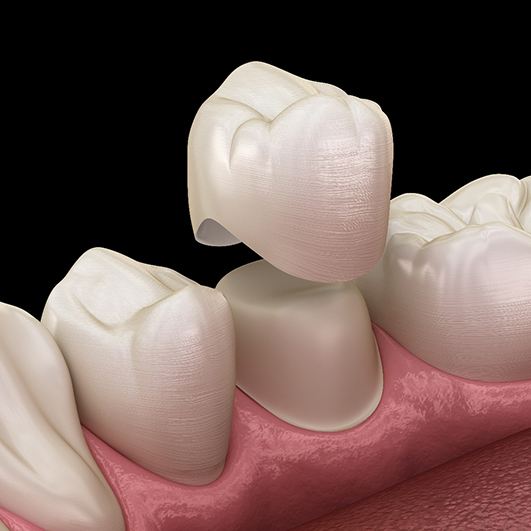 A computer-generated image of a dental crown