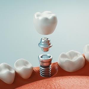 A 3D rendering of the various parts of a dental implant